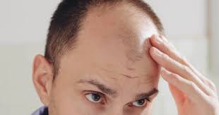 This will grow your hair back